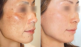 melasma treatment before & after picture